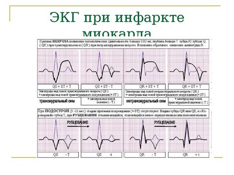 Экг при инфаркте миокарда фото пленок и расшифровка признаков