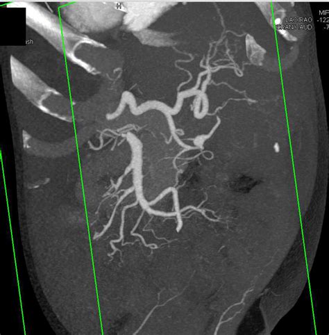 Subtle Aneurysm Off The Gastroduodenal Artery Gda Seen Only On Cta 3d Images Vascular Case