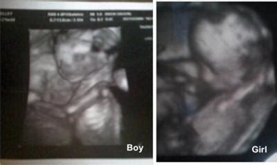 Twins - 3D Ultrasound