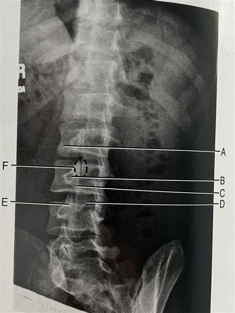 Oblique L Spine Diagram Quizlet