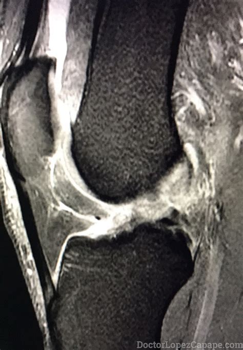 Ruptura Del Ligamento Cruzado Anterior Asociada Con Tumor De Rodilla