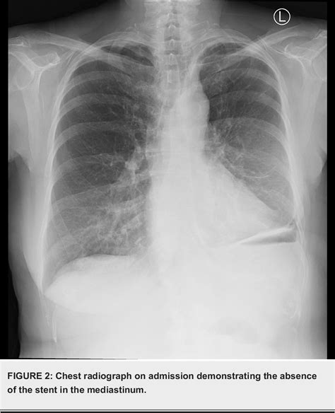 Pdf Small Bowel Obstruction Secondary To Migration Of A Fractured