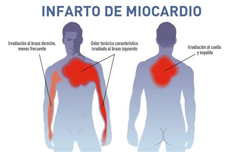 Infarto De Miocardio Policlínico San Miguel