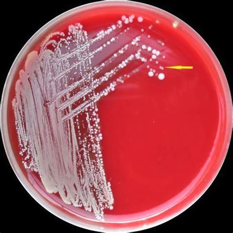 Burkholderia Cepacia Infection