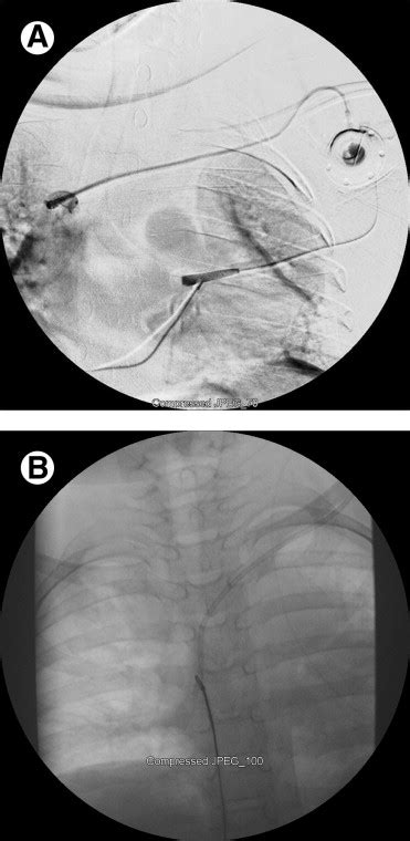 Evaluation And Management Of Central Venous Access Complications