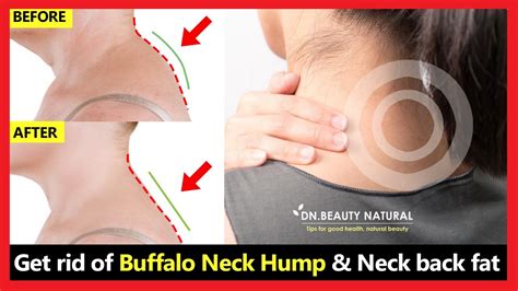 Easy Fix For The Neck Hump With Free Exercise Sheet Atelier Yuwa