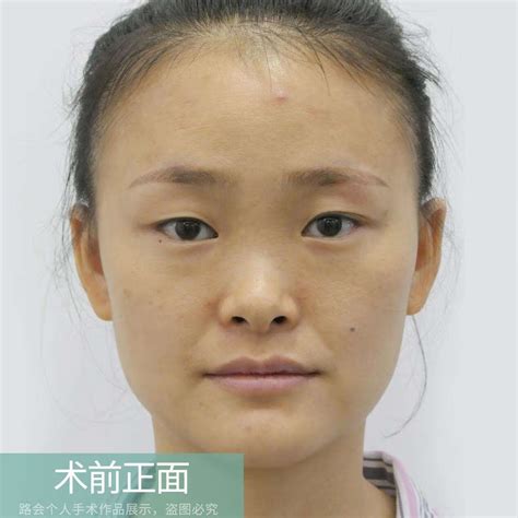 鼻整形手术效果真实记录5个月看看淡颜女生是如何变美的 京东健康