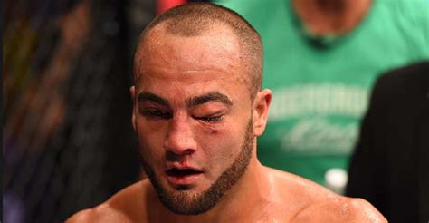 The 5 Most Broken Eye Orbitals In Ufc History Page 2 Of 5