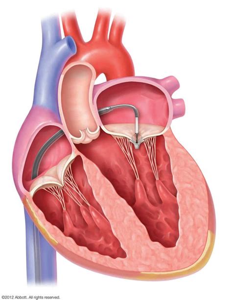 Mitral Und Trikuspidalklappenfehler Herz Und Diabeteszentrum NRW