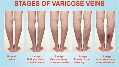 Varicose Veins Flashcards Quizlet