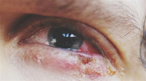 8 Common Eye Symptoms And What They Mean