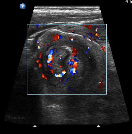 Intussusception Image Radiopaedia Org