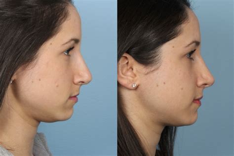 Before After Pictures Revisions Rhinoplasty Chicago Il Dr Sidle