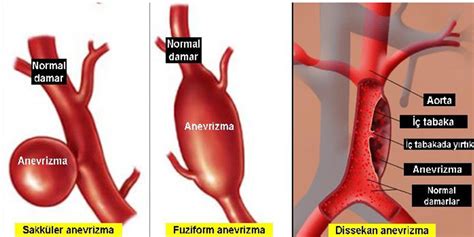 Fikir Transplantasyonu Aort Anevr Zmasi Hem Rel K Bakimi