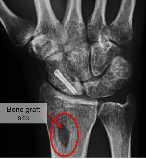 Scaphoid Fracture Raleigh Hand Surgery — Joseph J Schreiber Md