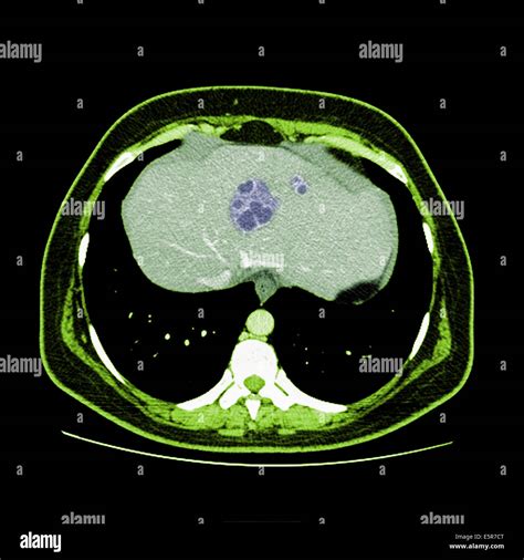 Le Scanner Couleur Scan De Labdomen Abces Hépatique Montrant Des Taches Bleues Au Centre