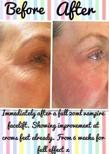 Before And After Pictures Of Vampire Facelift (2) » Facelift: Info ...