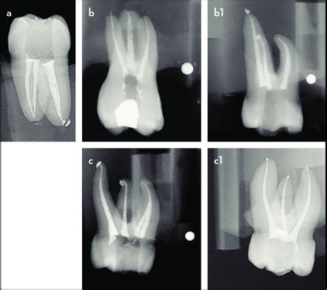 Examples Of Obturation Outcomes Of The 3d Printed Tooth A And For