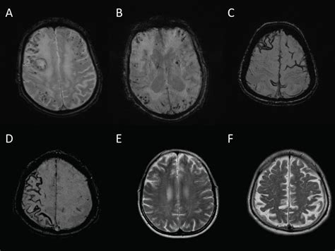 Cerebral Amyloid Angiopathy And Intracerebral Haemorrhage