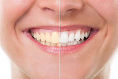 Why Do Teeth Turn Yellow Teeth Whitening Reen Chung Dds