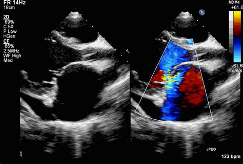 Interpretando O Guideline De Estenose Mitral Reum Tica Ase Blog