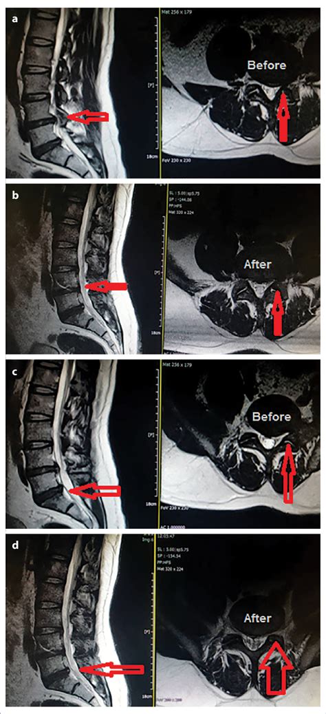 The Magnetic Resonance Imaging Images Before A And After B The Ioc