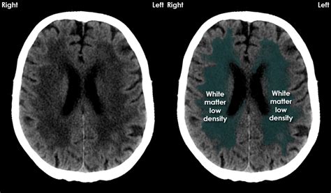 Acute CT Brain - Chronic ischaemia