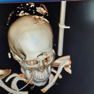 Axial Brain Ct Scan Showing Transcalvarial Brain Parenchymal