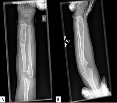 Joseph Nassar On Linkedin Infantile Fibrosarcoma Of The Bone A Case