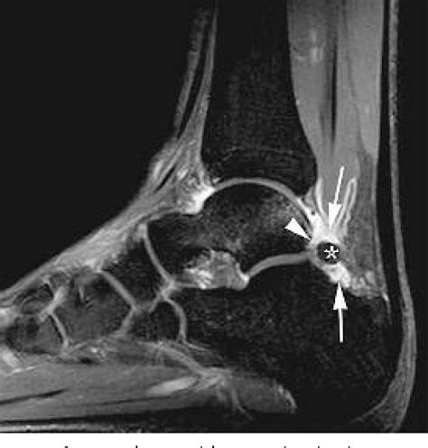 Pdf Ankle Impingement Syndromes Semantic Scholar