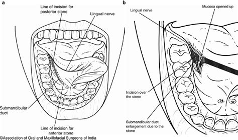 18 (a, b) Technique of sialolith removal from submandibular duct ...