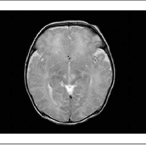 T2 Weighted Axial Magnetic Resonance Imaging Mri Demonstrating