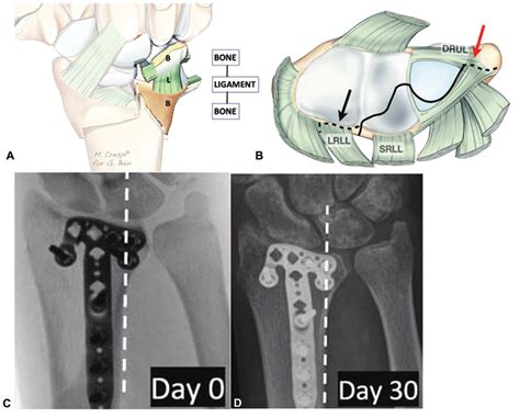 Osteoligamentous Concept Of Distal Radius Fractures A Volar Ulnar