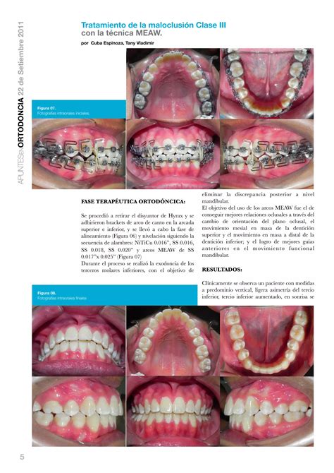 Tratamiento De La Maloclusión Clase Iii Con La Técnica Meaw Pdf