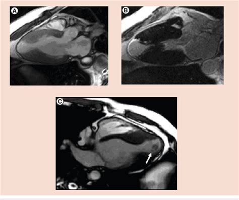 Advances Of Cardiovascular Mri In Hypertrophic Cardiomyopathy