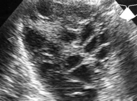 Normal Vs Polycystic Ovaries Ultrasound