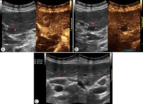 Ceus Features Of The Hcc Nodule At Segment Ii Ceus Li Rads Lr A