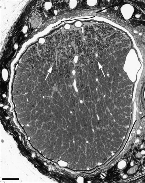 Optic nerve cross section, 8 days after transection superiorly. This ...