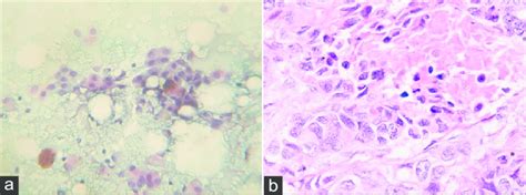 (a) Bronchoscopic biopsy of lung showing neoplastic cells with keratin... | Download Scientific ...