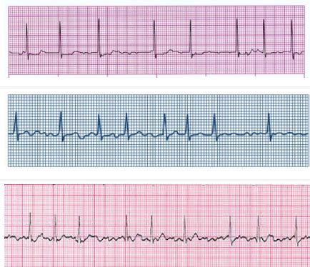 Ekg Practice Flashcards Quizlet