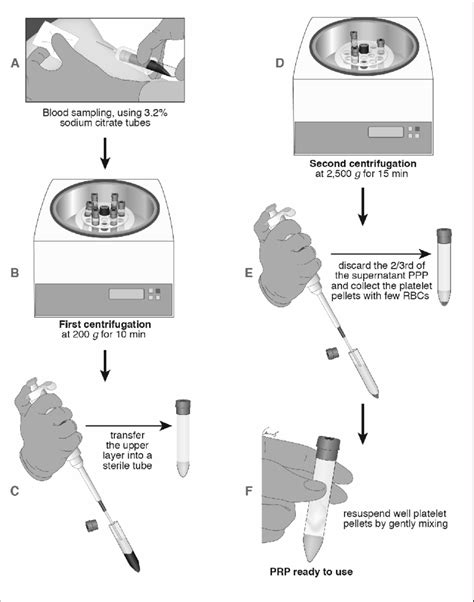 Flow Chart In Platelet Rich Plasma Prp Preparation Ppp