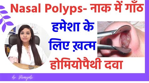 Nasal Polyps Treatment Homeopathy For Nasal Polyps Nasal Polyps