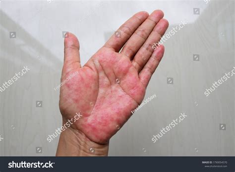 Atopic Dermatitis Palms