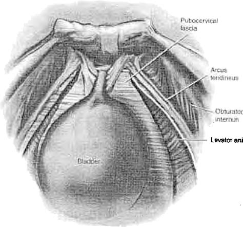 Figure 2 From Laparoscopic Paravaginal Repair Plus Burch