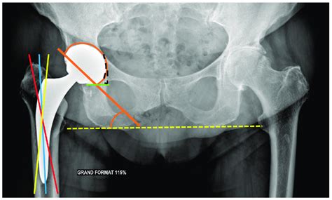 Acetabular Frontal Inclination And Femoral Stem Position Pelvic