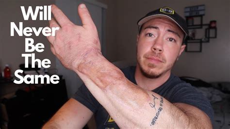 Ftm Consider This Before You Choose Phalloplasty Arm Update Youtube