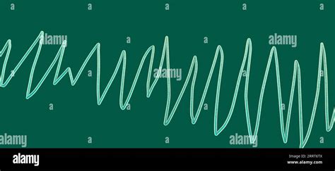 Illustration of an electrocardiogram (ECG) showing Torsades de pointes ...