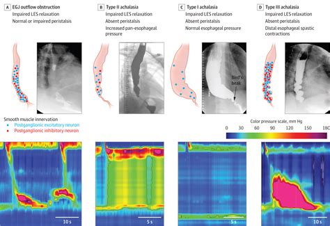 Achalasia A Systematic Review Gastroenterology Jama Jama Network