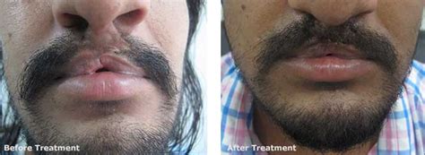 Beard And Moustaches Transplant At Aura Skin Institute Chandigarh India