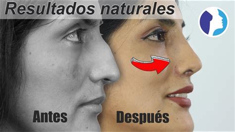 RinoplastÍa Estética Y Funcional 👃🏼 Resultado Natural ️